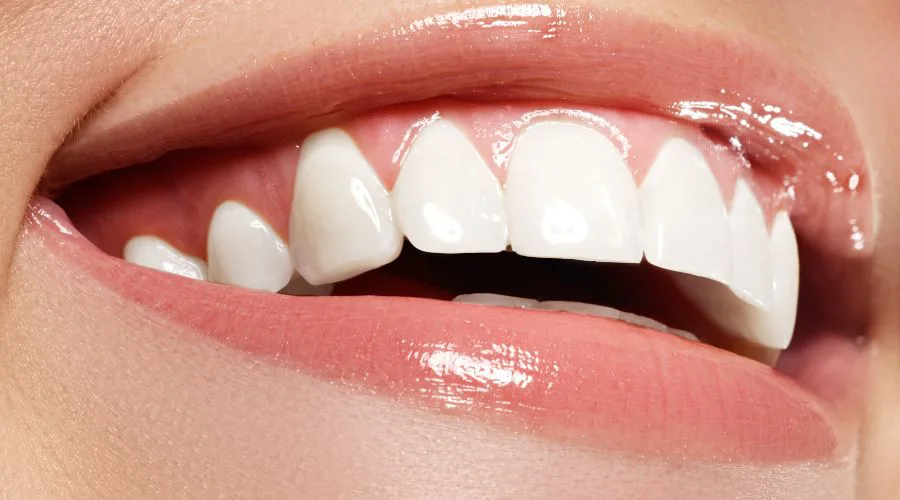 Dental Implants in Turkey - A Quick and Affordable Solution 2 Best Dental Implants in Turkey