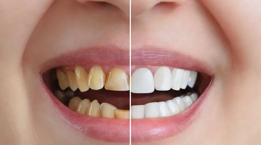 Dental Implants in Turkey - A Quick and Affordable Solution 6 Dental Implant in Turkey