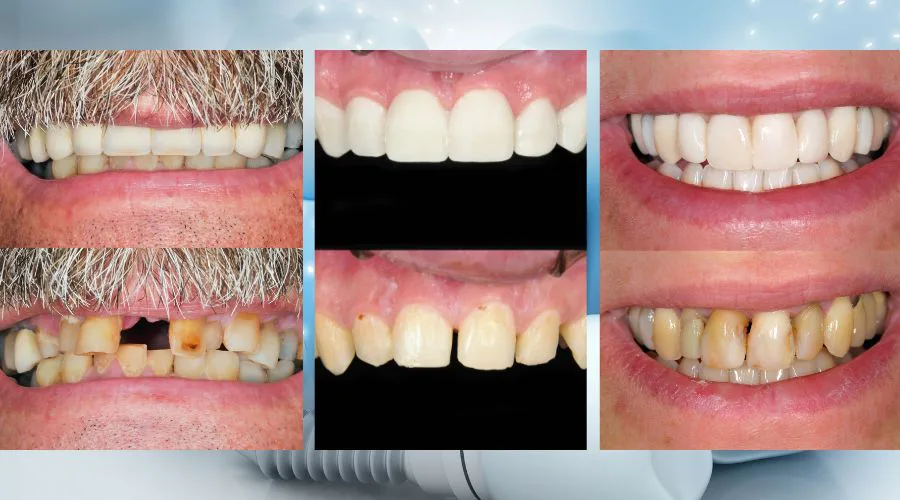 Dental Implants in Turkey - A Quick and Affordable Solution 7 Is it safe to have dental implants in Turkey