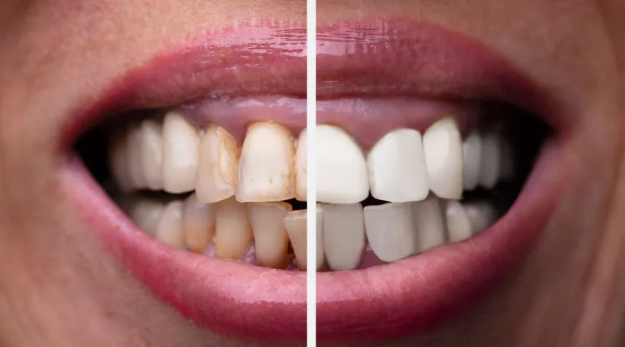Dental Implants in Turkey - A Quick and Affordable Solution 4 cost of dental implants in turkey