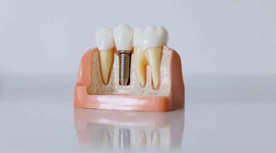 Dental Implants in Turkey - A Quick and Affordable Solution 5 Cost of Dental Implants in Turkey