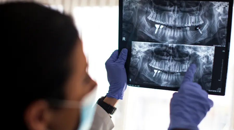 Dental implant surgery in Antalya Türkiye